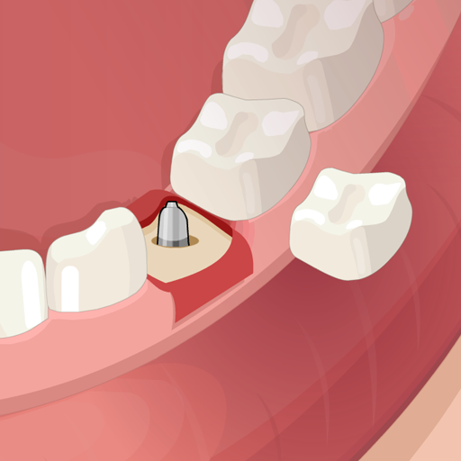 بازی ایمپلنت دندان